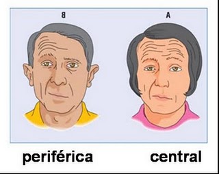 Paralisia-Facial